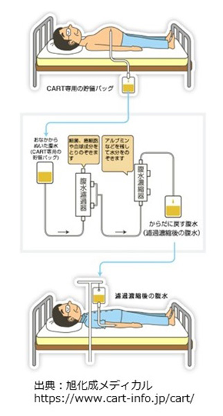 腹水濾過濃縮再静注法